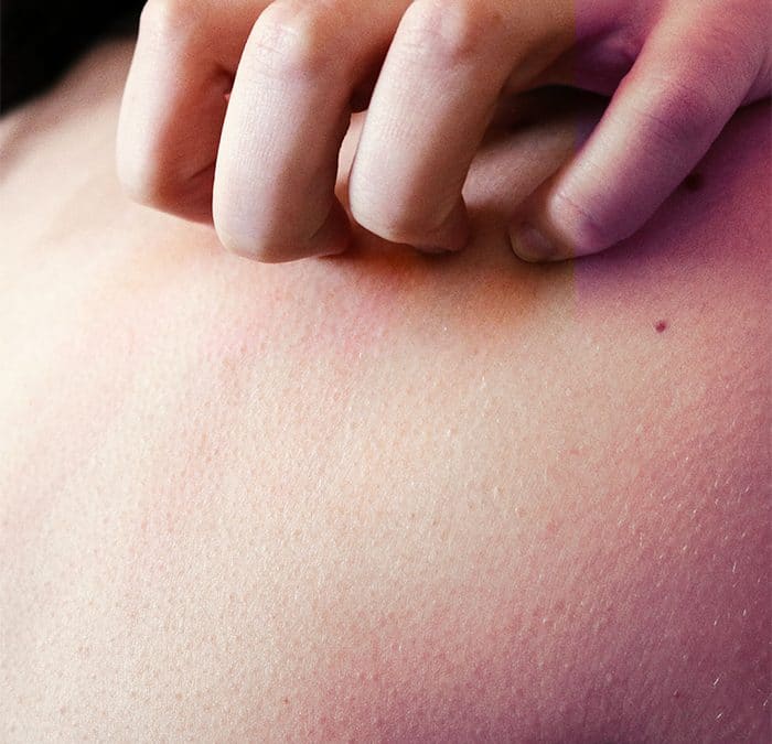 como cuidar da pele sensível